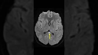 Cytotoxic lesion of the corpus callosum mribrain virlshorts [upl. by Aivax68]