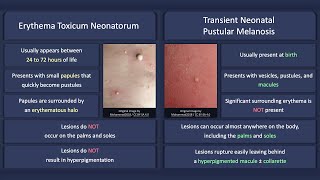 Erythema Toxicum Neonatorum vs Transient Neonatal Pustular Melanosis [upl. by Catherina]