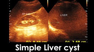 Simple Liver cyst  Enlarge prostate  Practical case [upl. by Tnert132]