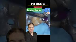 Resina dental como se hace un empaste o relleno en la boca shorts [upl. by Chenee]