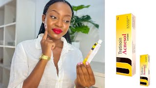 ACNESOL TRETNOIN CREAM JOURNEY  Review [upl. by Peedus218]