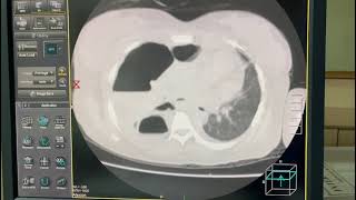 CT scan of 20F with Hydropneumothorax under immunosuppression for SLE [upl. by Danzig]