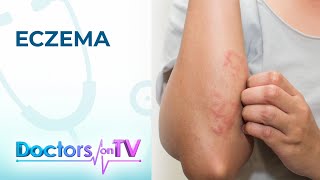 Eczema Symptoms Causes and Treatment  Doctors on TV [upl. by Phila]