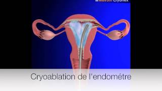 Cryoablation de lendomètre [upl. by Ollopa31]