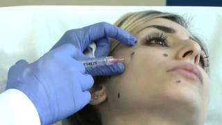 Profhilo  Advanced AntiAging Facial Skin Rejuvenation Treatment  The Youth Doctor  Birmingham [upl. by Perlman]