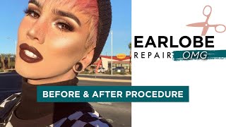 Earlobe Repair Surgery Post Plugs BEFORE amp AFTER [upl. by Kcirtapnaes]