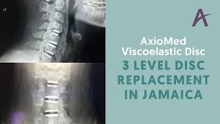 3 Level AxioMed Viscoelastic Disc Replacement in Jamaica [upl. by Travis924]