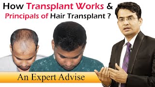 Hair Transplant Facts you must know  MEDISPA Hair Transplant INDIA  Dr Suneet Soni Jaipur  Delhi [upl. by Hitchcock425]