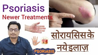 सोरायसिस के नये इलाज़  Psoriasis Newer Treatments  Tofacitinib  Infliximab  Adalimumab psoriasis [upl. by Zebadiah]