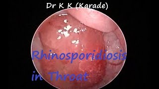 Rhinosporidiosis  In Nasal amp Oral Cavity [upl. by Aiclef]