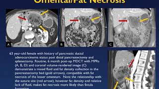 Primer on Distal Pancreatectomy [upl. by Olemrac]