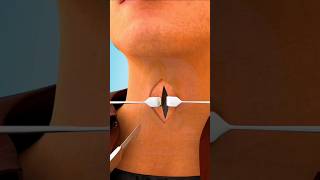 Tracheostomy Surgery Tracheostomy procedure 3D animationTracheostomy Tubeviralshortsdrsadiayt [upl. by Reivaj]