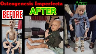 Osteogenesis Imperfecta CASE 1Video 6 Started Standing amp Taking Steps after 18 years of waiting [upl. by Tollman362]