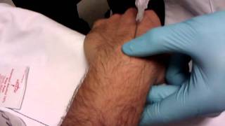 Ganglion cyst Aspirationremoval done right [upl. by Kesia]