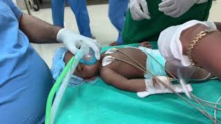 Endotracheal Intubation for a kid with bilateral cleft lip  Richardsons [upl. by Elisee]