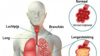Longontsteking symptomen en remedies [upl. by Mishaan106]