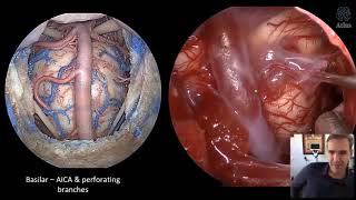 Chordomas and Chondrosarcomas Surgical Anatomy and Technical Nuances [upl. by Loma]