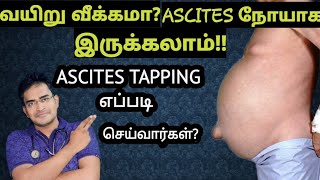 Ascites causesamp treatment explanation in tamilmedical awareness in tamil [upl. by Yellah]