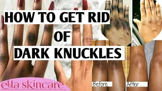 HOW TO GET RID OF DARK KNUCKLES  Causes amp Treatment  Skincare Specialist [upl. by Atekehs521]