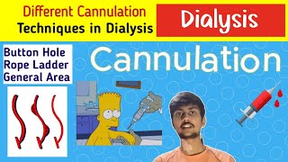 AVF Cannulation Techniques Explained A Dialysis Guide [upl. by Sifan]