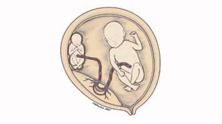 What is twintotwin transfusion syndrome TTTS [upl. by Eisiam]