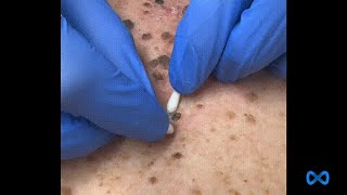 Large Blackheads on the Back [upl. by Acissey11]