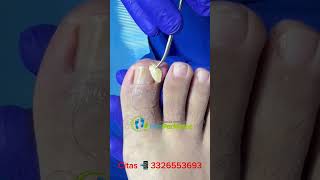 Caso de FIBROMA Solución definitiva satisfying ingrowntoenailsurgery [upl. by Kcirdle77]