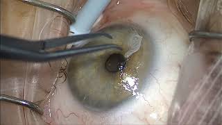 4 Main Lens IOL Types for Cataract Surgery Pros and Cons Basic Version [upl. by Barbette]