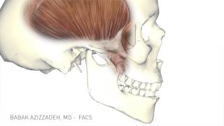 Temporalis Tendon Transfer  Facial Paralysis Surgery [upl. by Rossi]