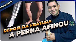 FRATURA DE TÍBIA E FÍBULA PERNAS FICAM FINAS  ATROFIA MUSCULAR [upl. by Eimile]