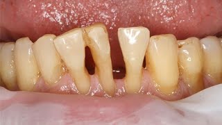 Treatment of Periodontal DiseaseBefore and After [upl. by Airemaj]