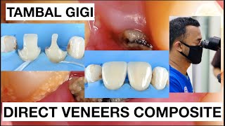 Step by Step Direct Veneer Composite Restoration  Dentist Griya RR [upl. by Herminia637]