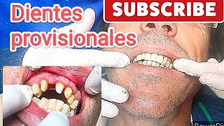 Cómo hacer tus dientes provisionales en 10 minutos [upl. by Wartow358]