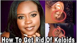 How To Remove Keloid Permanently [upl. by Mossberg253]