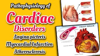 Pathophysiology of Cardiac disorders  Angina pectoris amp its types  Myocardial infarction amp Causes [upl. by Arand]