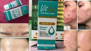 vitlox anti acne cream vit lox anti acne cream The skin hub ll beautywithashiza [upl. by Anerbas]