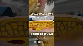 LIPO E ENXERTO NO BUMBUM [upl. by Foss]