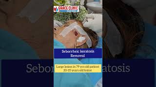 Seborrheic keratosis removal  Grace clinic Dehradun  Dr Naziya khatun [upl. by Asilej]