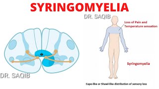 Syringomyelia [upl. by Oirasor]