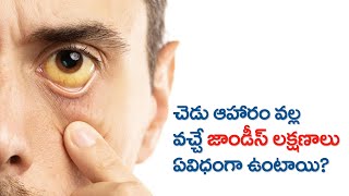 Jaundice  Symptoms  Causes  Treatment  Telugu  కామెర్లు లక్షణాలు జాగ్రత్తలు [upl. by Yand]