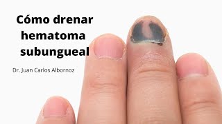 HEMATOMA EN LA UÑA COMO DRENARLO juancalbornoz Shorts hematomaungueal [upl. by Otilopih]