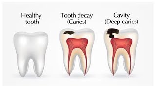 Dental Caries Tooth Decay [upl. by Yrreb1]