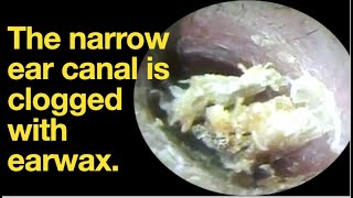 The narrow ear canal is clogged with earwaxear wax removal  ear cleaning  ASMR  relaxation [upl. by Richel]