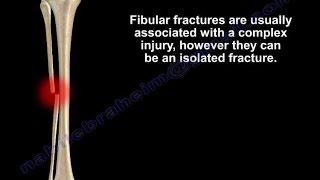 Fibular Fracture isolated Everything You Need To Know  Dr Nabil Ebraheim [upl. by Llevol468]