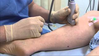 Foam sclerotherapy for varicose veins  Philip Coleridge Smith [upl. by Ynamad]