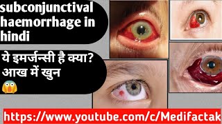 subconjunctival haemorrhage in hindi ये आपातकालीन इमर्जन्सी है क्या अांख के निचे खुन जमा होना [upl. by Mariandi]