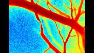 Speckle Contrast During Stroke  40 Minutes [upl. by Trawets]