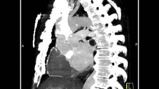 Cardiac Type B Dissection as well as Coronary Artery Disease 2 of 7 [upl. by Standing]