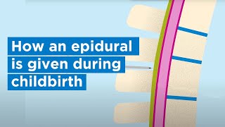 How an epidural is given during childbirth  Bupa Health [upl. by Delanie]