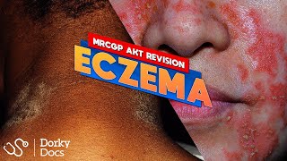 Eczema The MRCGP AKT Exam Revision I Dorky Docs [upl. by Ytsirk]